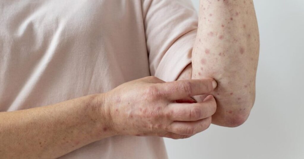 Internação de Jovem com Suspeita de Mpox no RN: O Que Você Precisa Saber