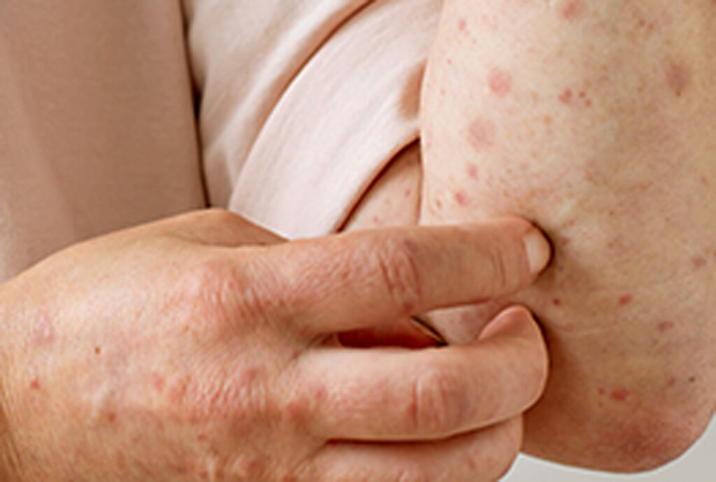 Secretaria de Saúde do RN Confirma Negativa para Monkeypox em Mossoró