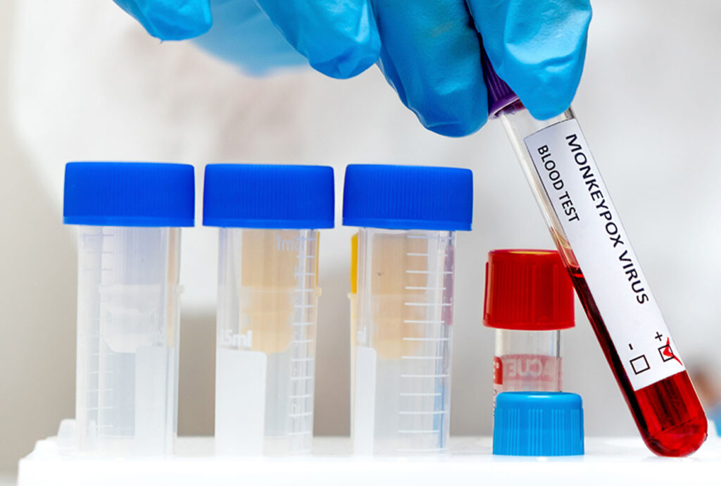 Sesap Reporta Três Novos Casos de Monkeypox no RN: O Que Podemos Aprender